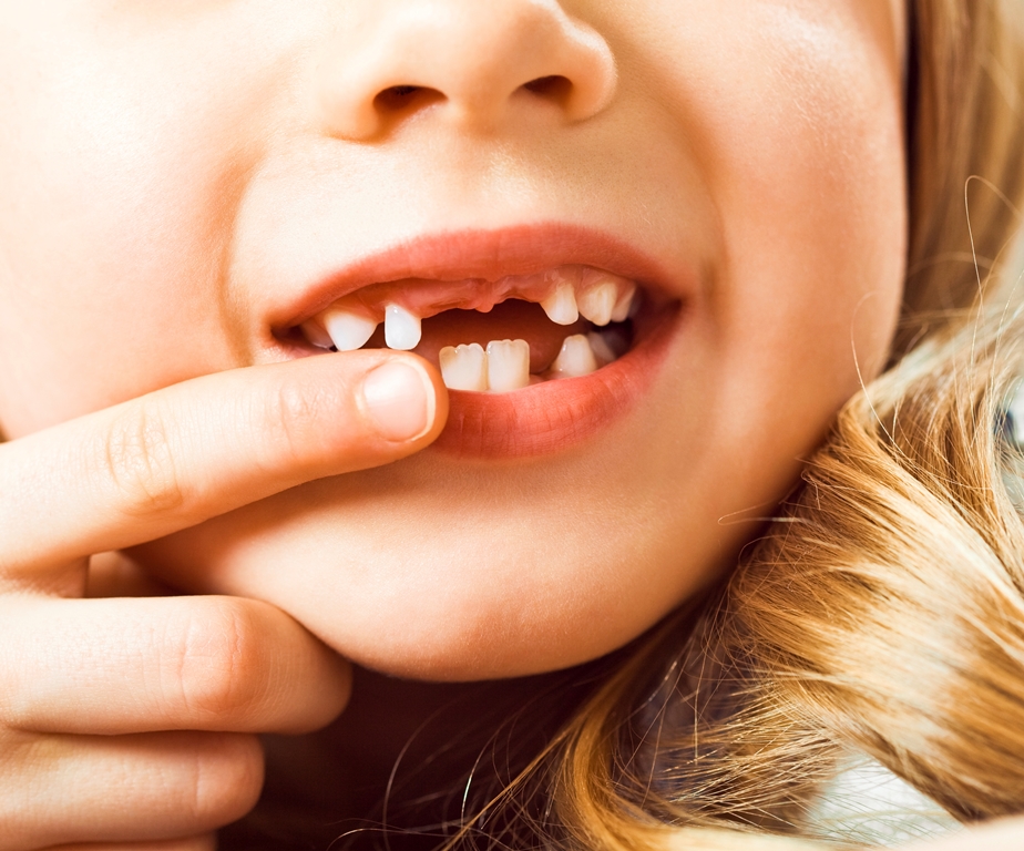 Care Somerset Dental | Dental Children Common in Problems 5