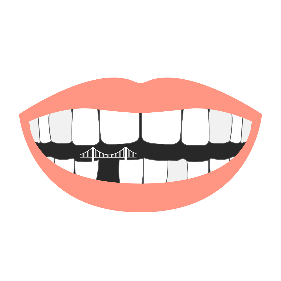 Don’t Mind The Gap – Build A (Dental) Bridge