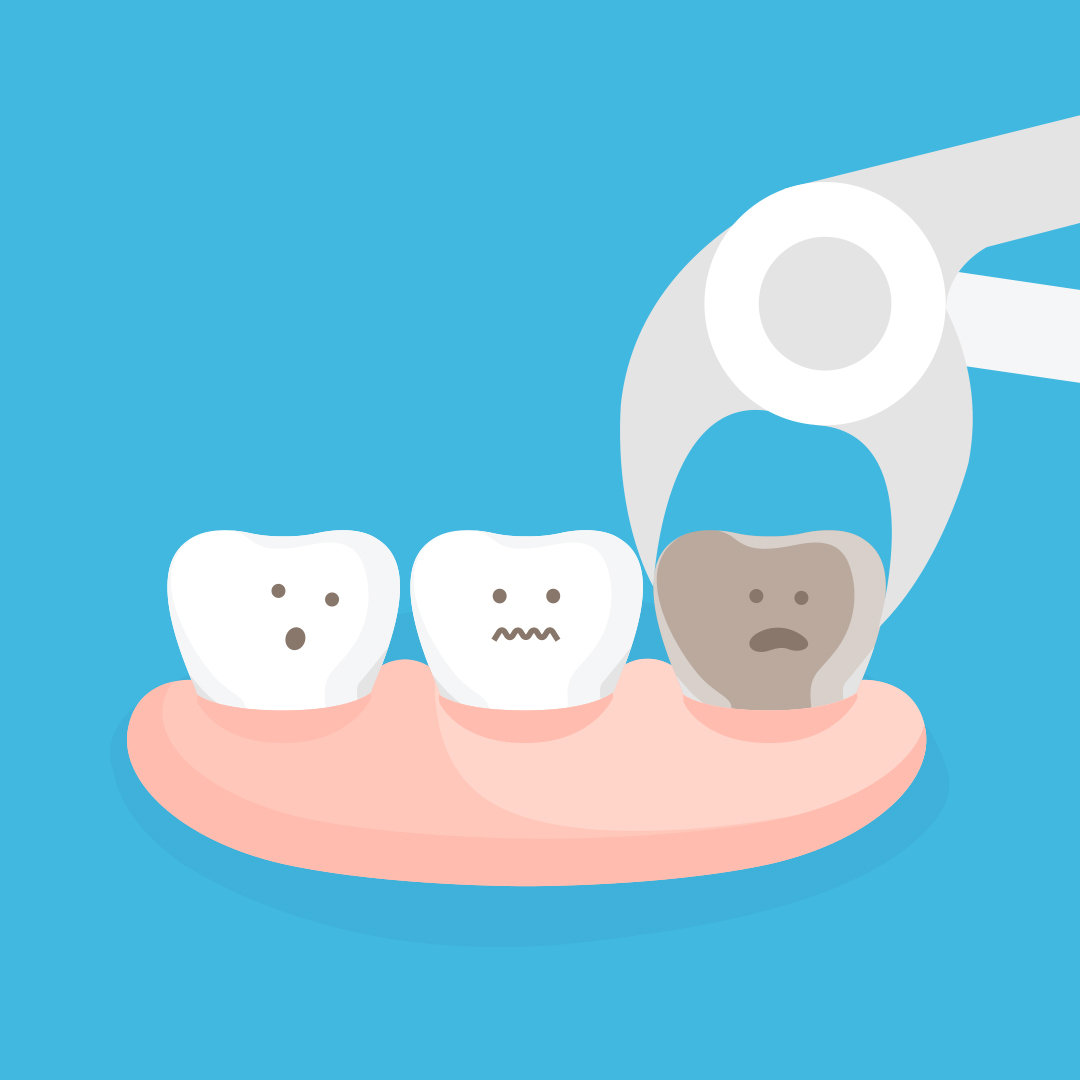 To pull or not to pull – do I need a tooth extraction?