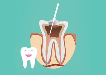 THE ROOT CANAL | Somerset Dental Care